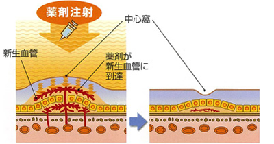 硝子体注射による薬効イメージ