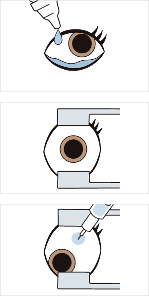 抗VEGF硝子体内注射の方法(図)